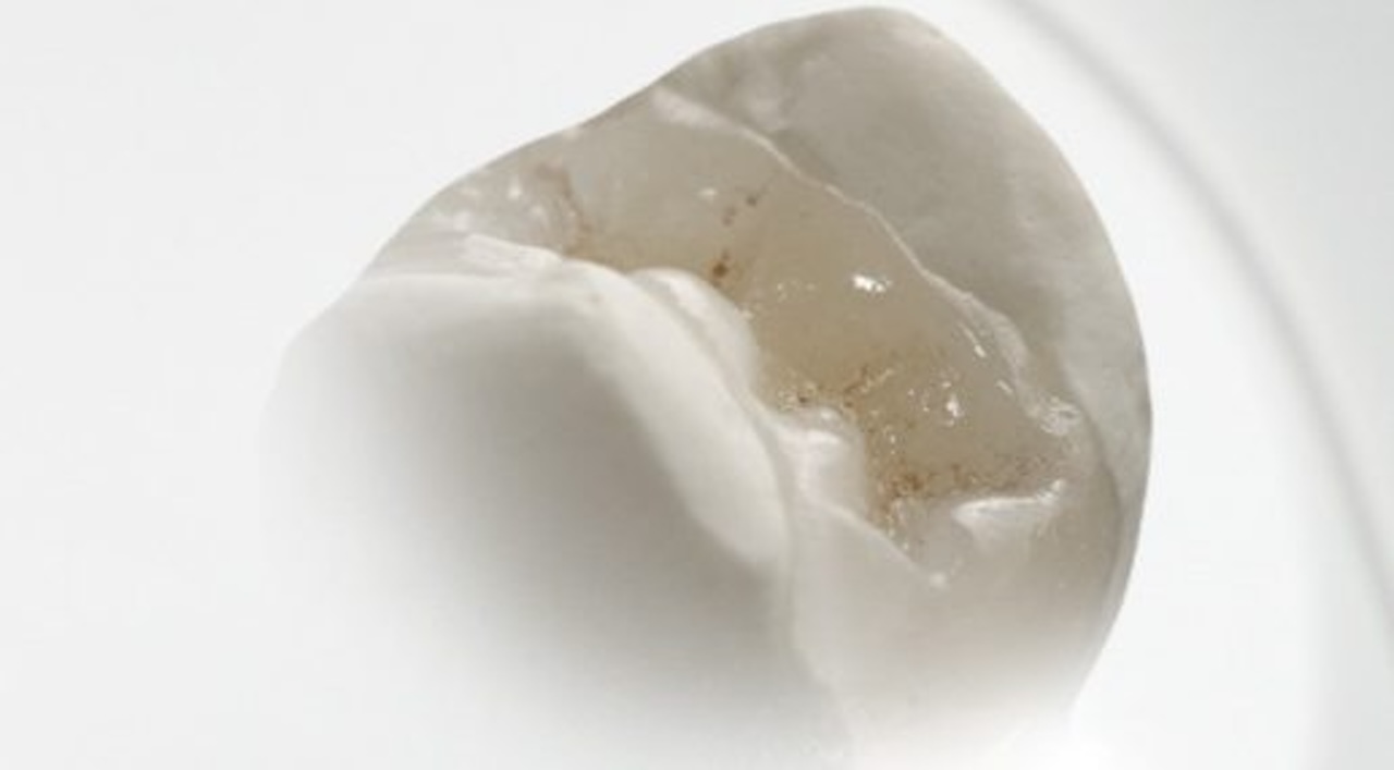 inlay-crop_1280 Nahaufnahme eines Zahn-Inlays in einem Zahnmodell aus weißem Gips